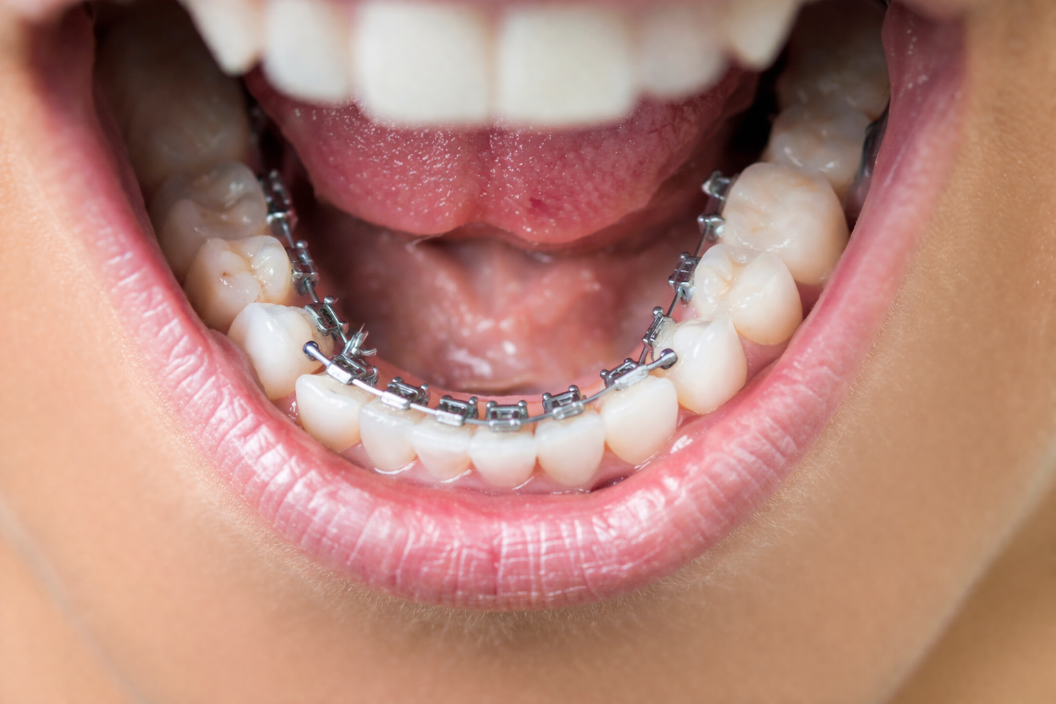 Lingual Braces